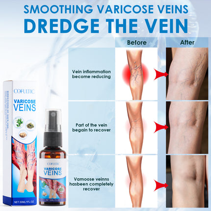 VeinCare 30ml Varicose Vein Spray - Promotes Blood Circulation & Comfo