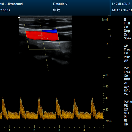 CMS1700C Color Doppler Portable Ultrasound Scanner With Probe