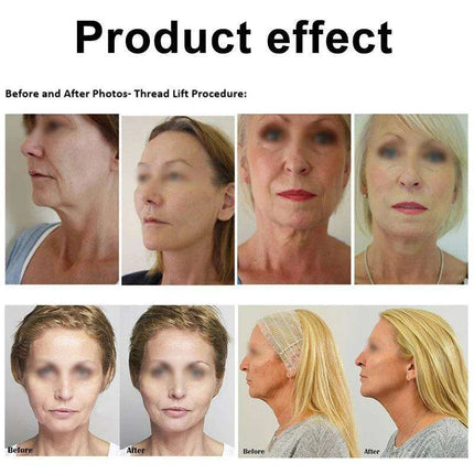 Youthful Glow Collagen Lift Threads Kit – At-Home Non-Invasive Skin Tightening Treatment for Radiant Skin