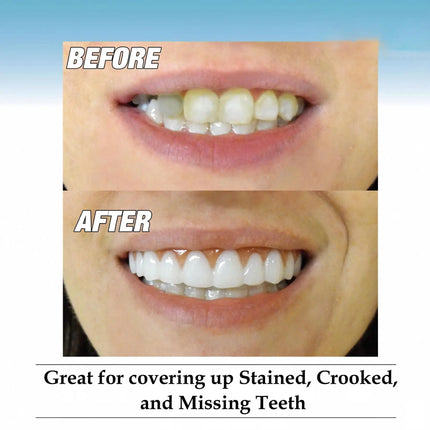 Silicone Cosmetic Dentures — Full Upper & Lower Set, Comfort Fit