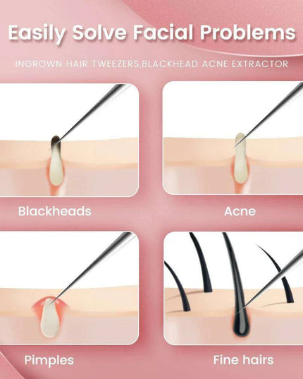 Ultra-Precision Blackhead Extractor: Advanced German Engineering for Radiant Skin