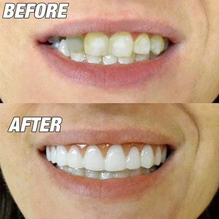Upper and Lower Cosmetic Tooth Covers