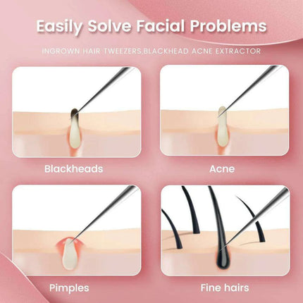 Ultra-Precision Blackhead Extractor: Advanced German Engineering for Radiant Skin - Très Elite